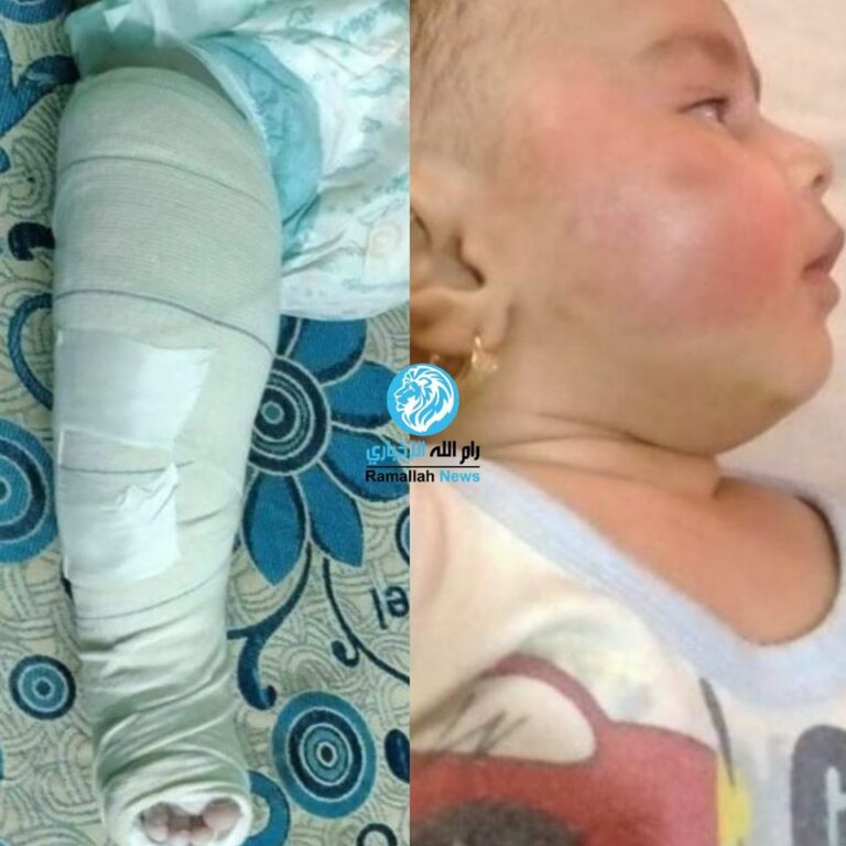 Un égyptien attaque sa petite fille de quelques mois en lui brisant le bras et le pied à cause de sa “haine pour les filles”